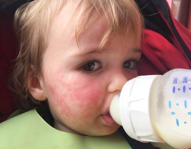 Alergia aguacate bebe