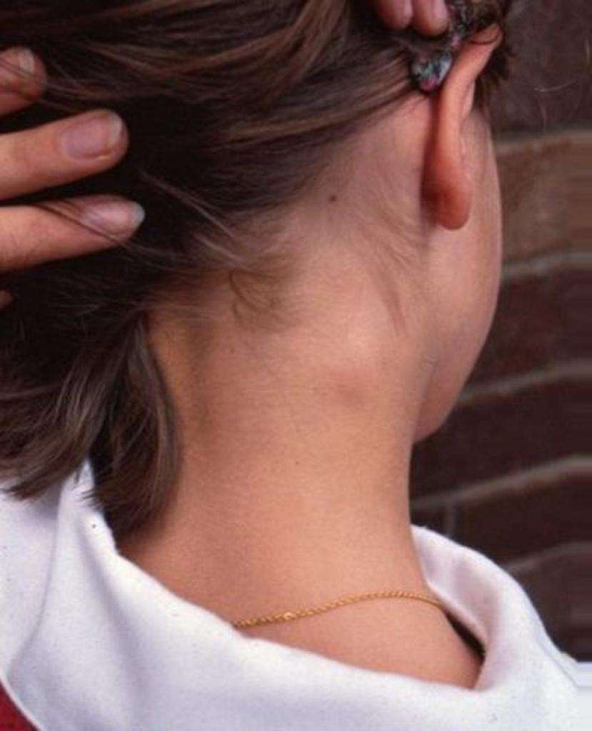 Увеличение лимфоузлов на шее у детей: воспаление и лечение – эл клиника