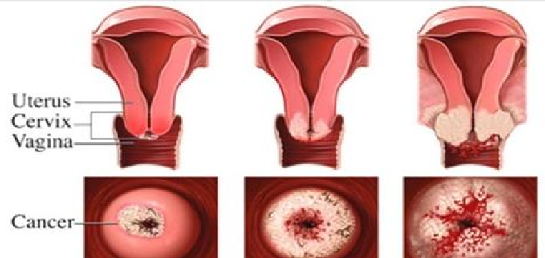 Лейкоплакия шейки матки: начнется ли рак — зависит от вас